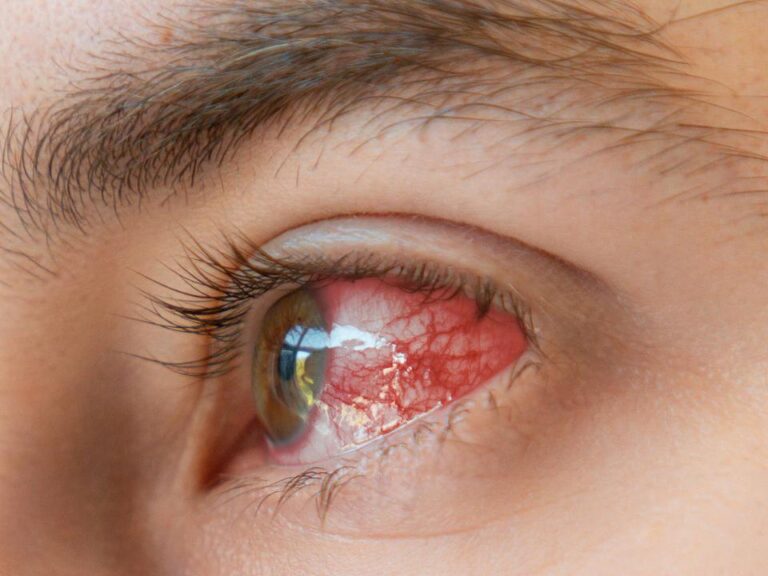 Sociedade Catarinense de Oftalmologia recomenda cuidados com os olhos no verão
